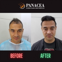 Hair Transplant - Before and After Result in Delhi