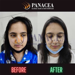 Hair Transplant Before and After Result in Delhi
