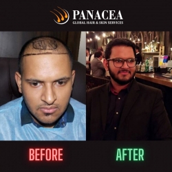 Hair Transplant in Delhi