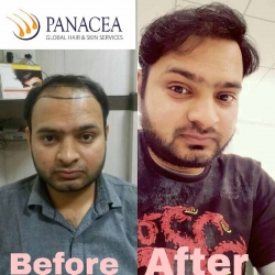 Hair Transplantation Result in Delhi