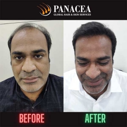 Hair Transplant After and Before Result in Delhi