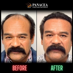Hair Transplantation - Before and After Result in Delhi