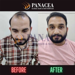 Before and After Result - Hair Transplant in Delhi