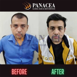 Panacea Global Best Hair Transplant in Delhi