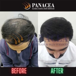 Panacea Real Result - Hair Transplant in Delhi