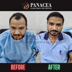 Panacea Real Result - Hair Transplant in Delhi