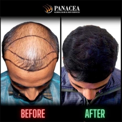 Panacea Global Hair Transplant in Delhi
