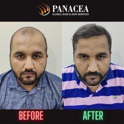 Panacea Global Hair Transplant Before and After in Delhi