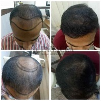 PRP Therapy Before and After Result