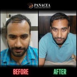 Hair Transplant Before and After Result in Delhi