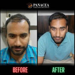 Hair Transplant Before and After Result in Delhi