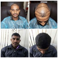 Hair Transplant Before and After Result