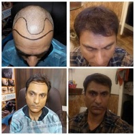 Hair Transplant Repair Before and After Result