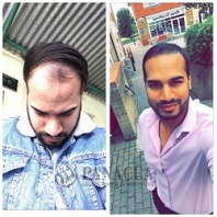 Hair Fall Treatment Before and After Result
