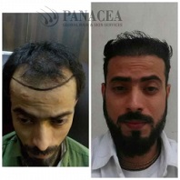 PRP Therapy Before and After Result