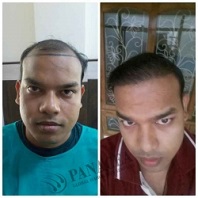 Hair Transplant Clinic Before and After Result