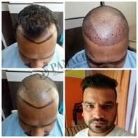 Hair Transplant Before and After Result