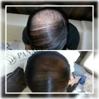 Hair Fall Treatment Before and After Result