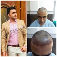 PRP Therapy Before and After Result