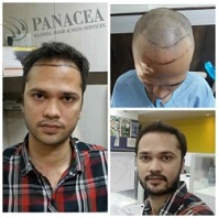 Hair Transplant Repair Before and After Result